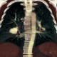 Pulmonary embolism, CT angiogram sign, pulmonary infarction: CT - Computed tomography